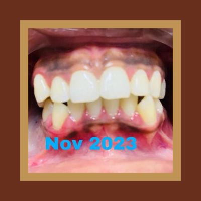 Braces Before Braces