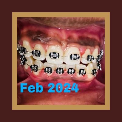 After Braces After image